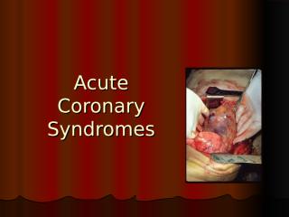 Acute Coronary Syndromes.ppt